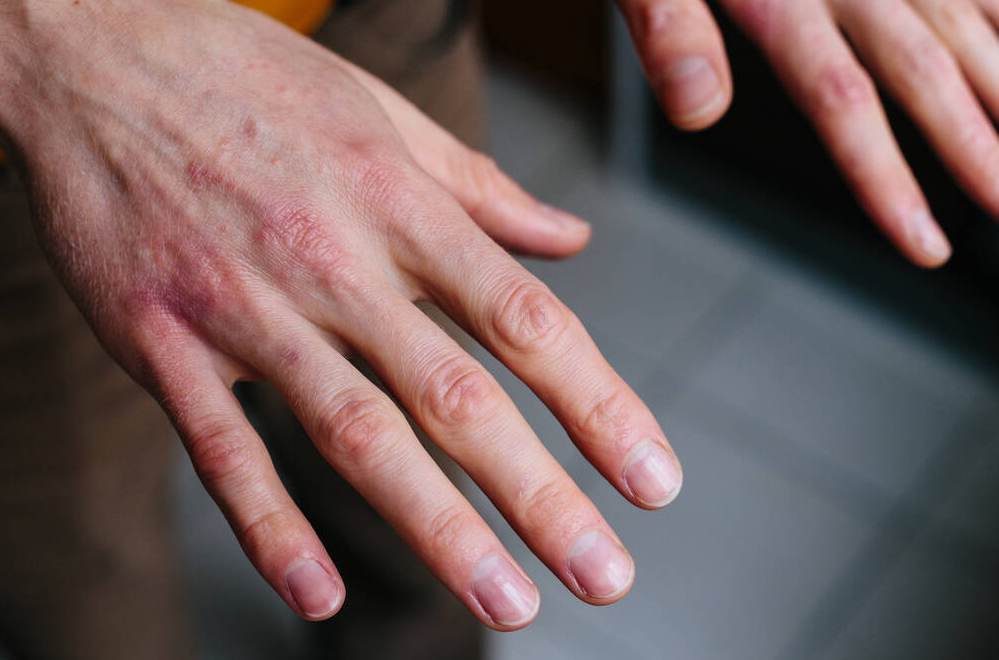 手上经常脱皮是什么原因,手部经常脱皮快速改善方法