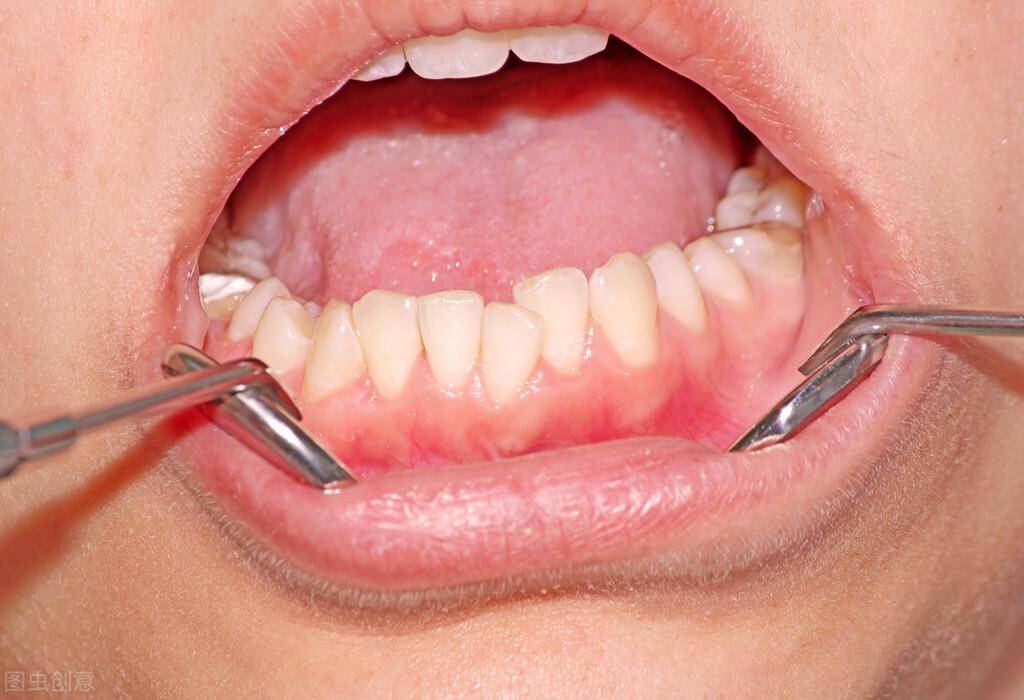 智齿长出来的前兆症状,判断自己的智齿正在生长情况方法