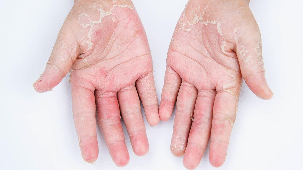 手掌脱皮是缺少什么维生素,手脱皮造成的主要因素