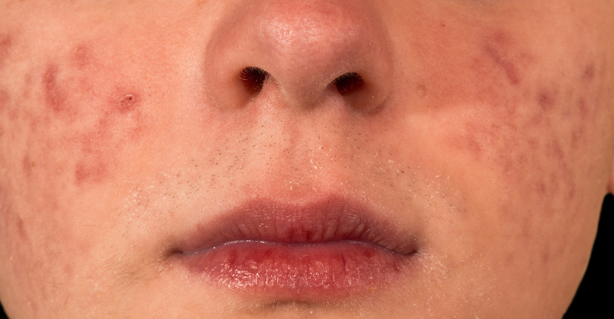 嘴巴里面长泡是什么原因,嘴巴长水泡的主要因素