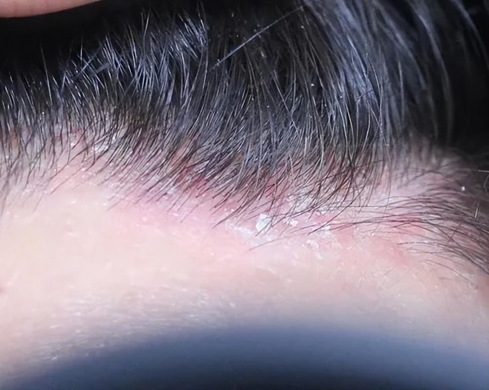 治疗头皮癣小妙招,头皮癣的症状及治疗方法