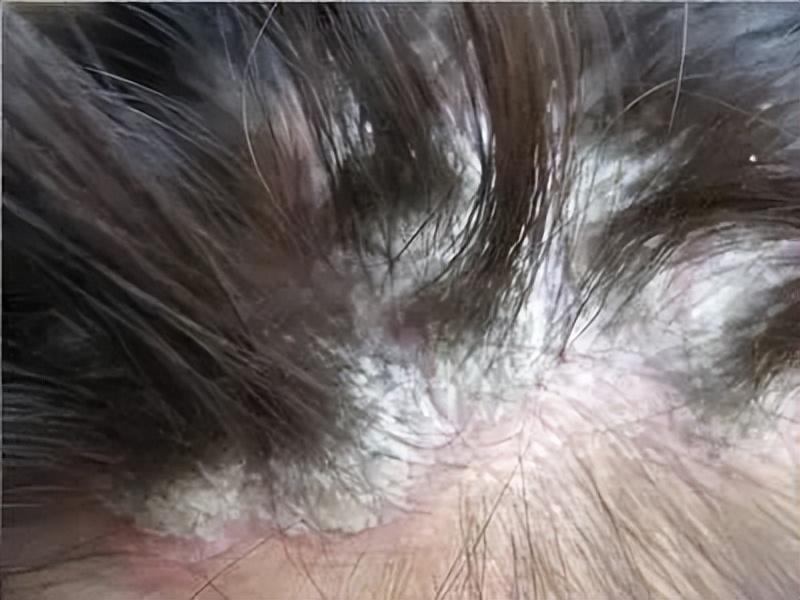 治疗头皮癣小妙招,头皮癣的症状及治疗方法