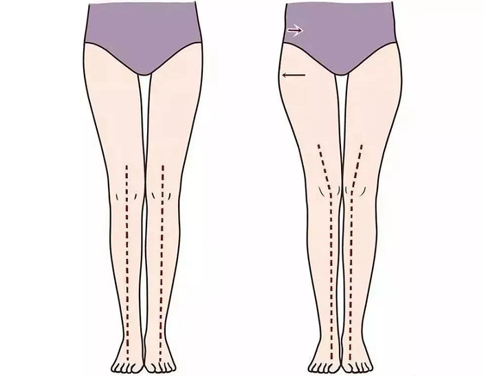 膝盖内扣怎么矫正,膝盖总是向内偏矫正方法