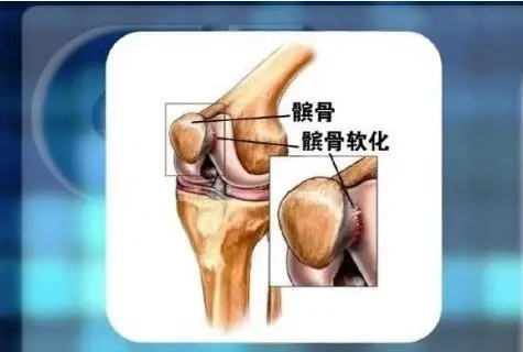 膝盖内扣怎么矫正,膝盖总是向内偏矫正方法