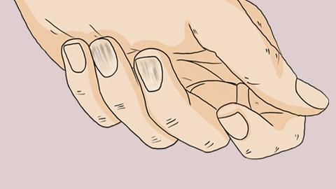 指甲上都是竖纹是什么原因,手指甲上常出现竖纹的主要因素