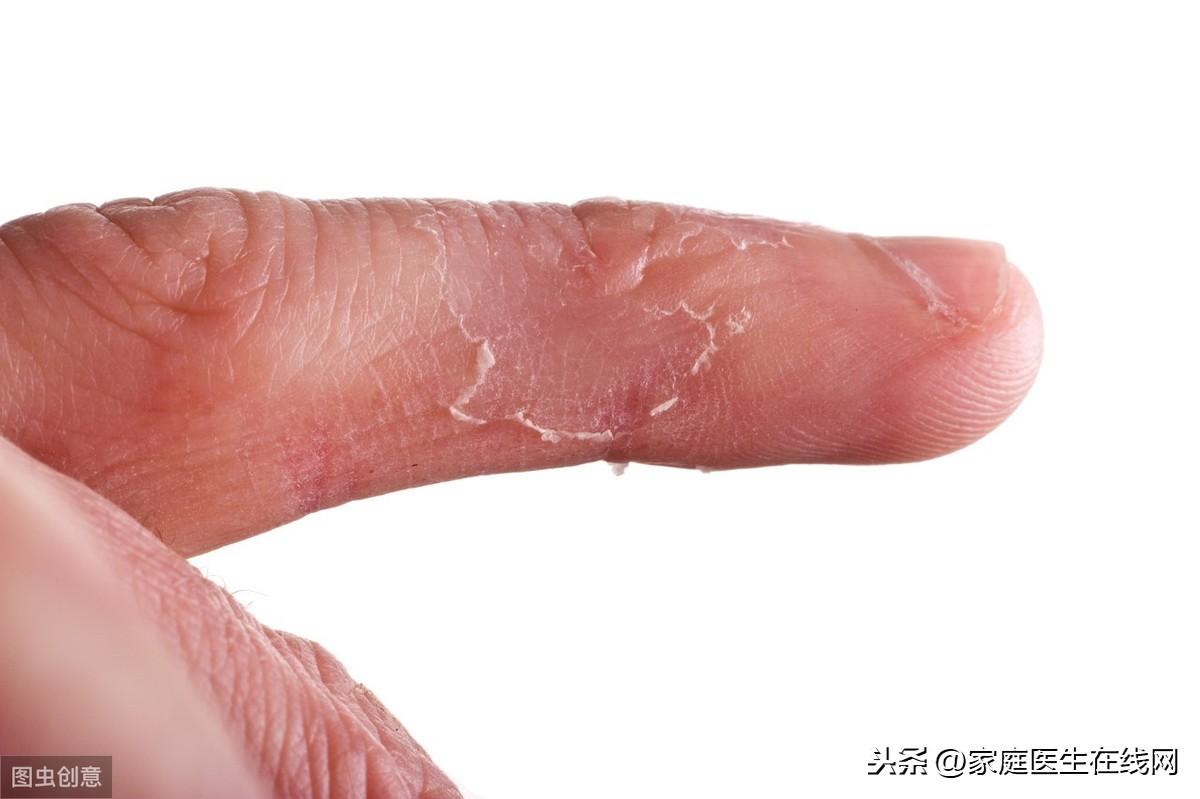 手爆皮是缺什么维生素,手部经常脱皮的主要原因