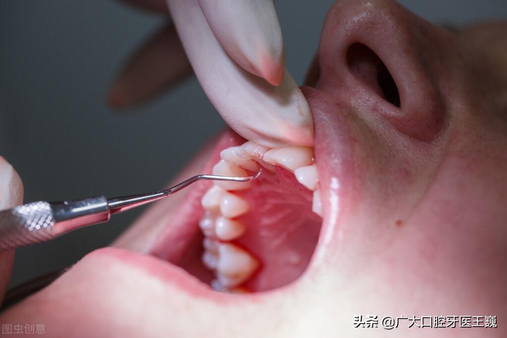 龈下刮治能治好牙周炎吗,龈下刮治后注意事项